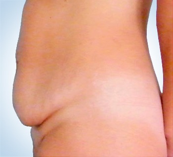 Abdominoplasty Surgery (Tummy Tuck)