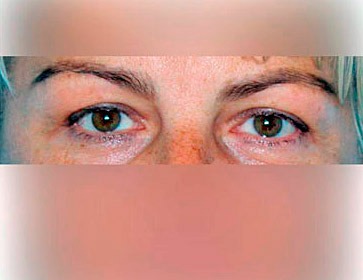 Upper Eyelid Surgery – Blepharoplasty