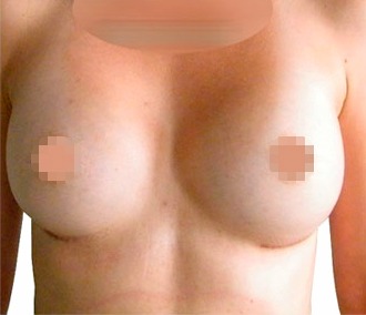 Breast Augmentation with Implants