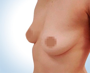 Zvětšení prsou implantáty