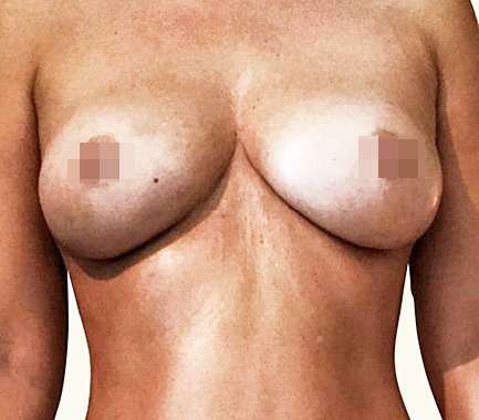 Brustvergrößerung mit Eigenfett – Lipotransfer