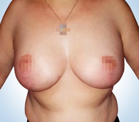 Zmenšení a modelace prsou