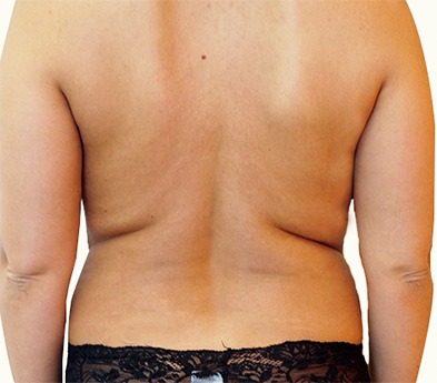 Liposuction – One Area