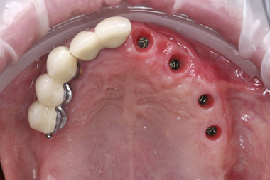 Dental bridge on implants